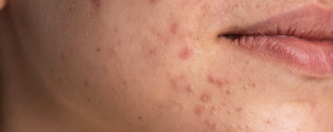 Skin Analysis