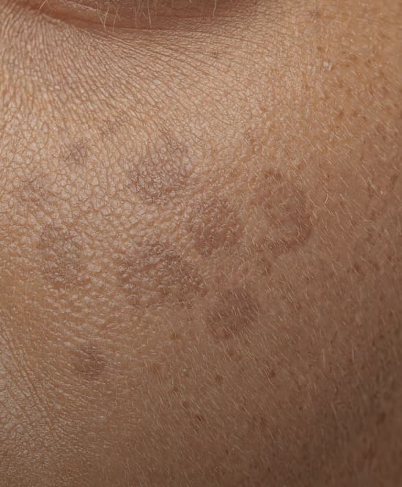 Skin Analysis